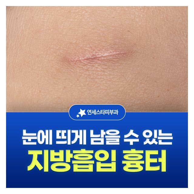 지방흡입 흉터, 눈에 띄게 남을 수 있어 빨리 치료하는게 좋습니다